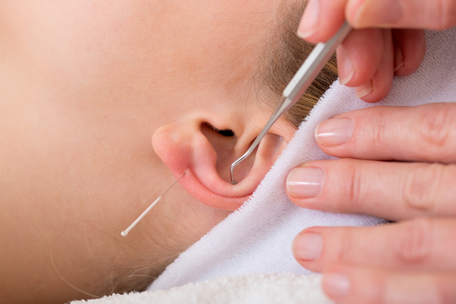 prestation acupuncture et auriculothérapie à la reunion 974