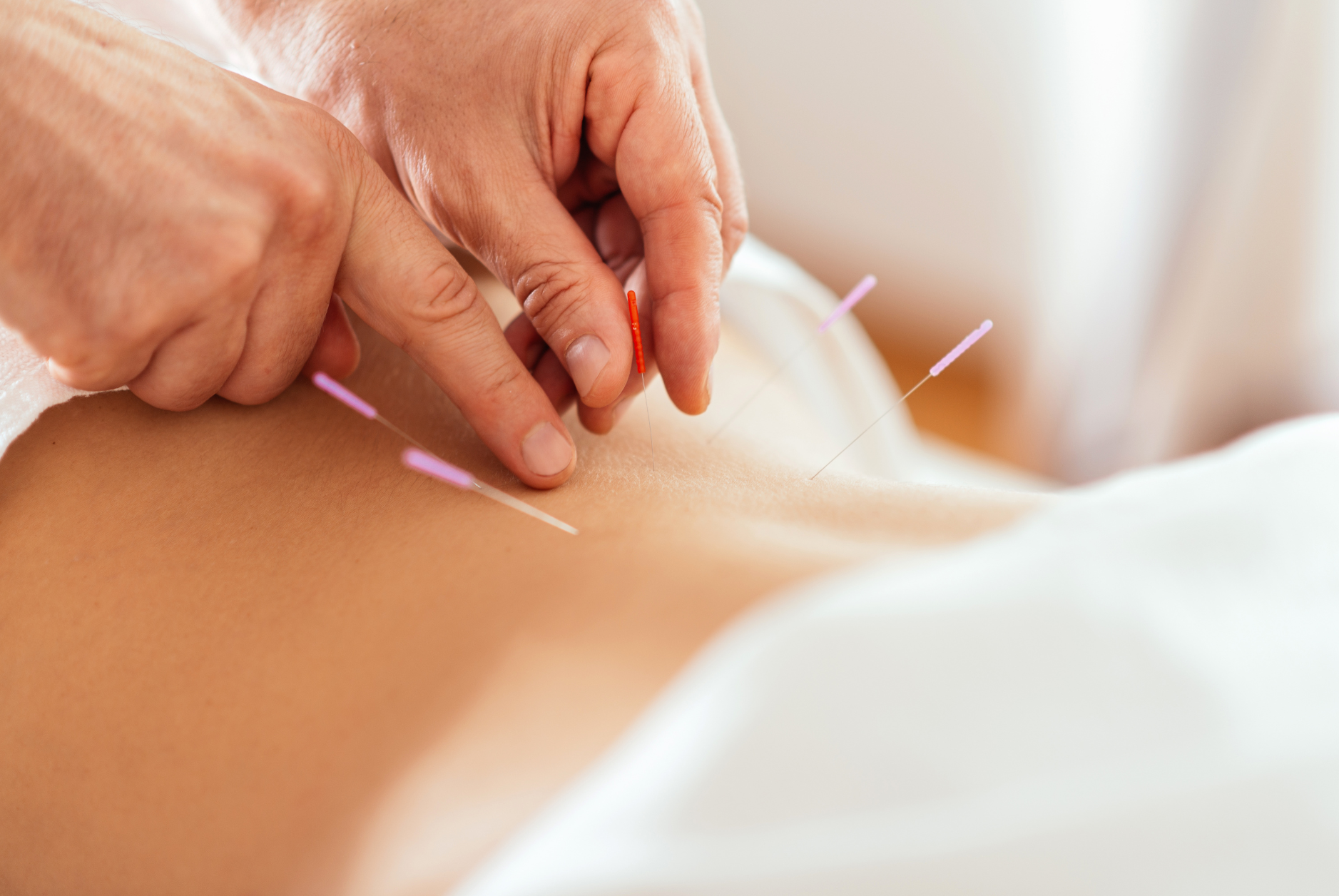 prestation acupuncture à la reunion 974